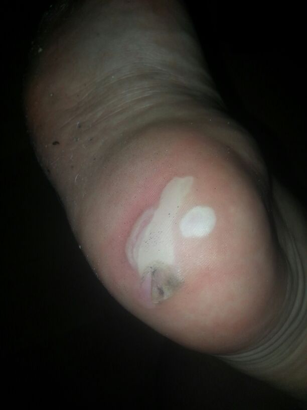 Grosse Entzundete Blase Am Fuss Muss Ich Zum Arzt Bild Im Anhang Gesundheit Und Medizin Haut Arztbesuch Grosse Entzundete Blase Am Fuss Muss Ich Zum Arzt Bild Im Anhang Gesundheit Und Medizin Haut Arztbesuch