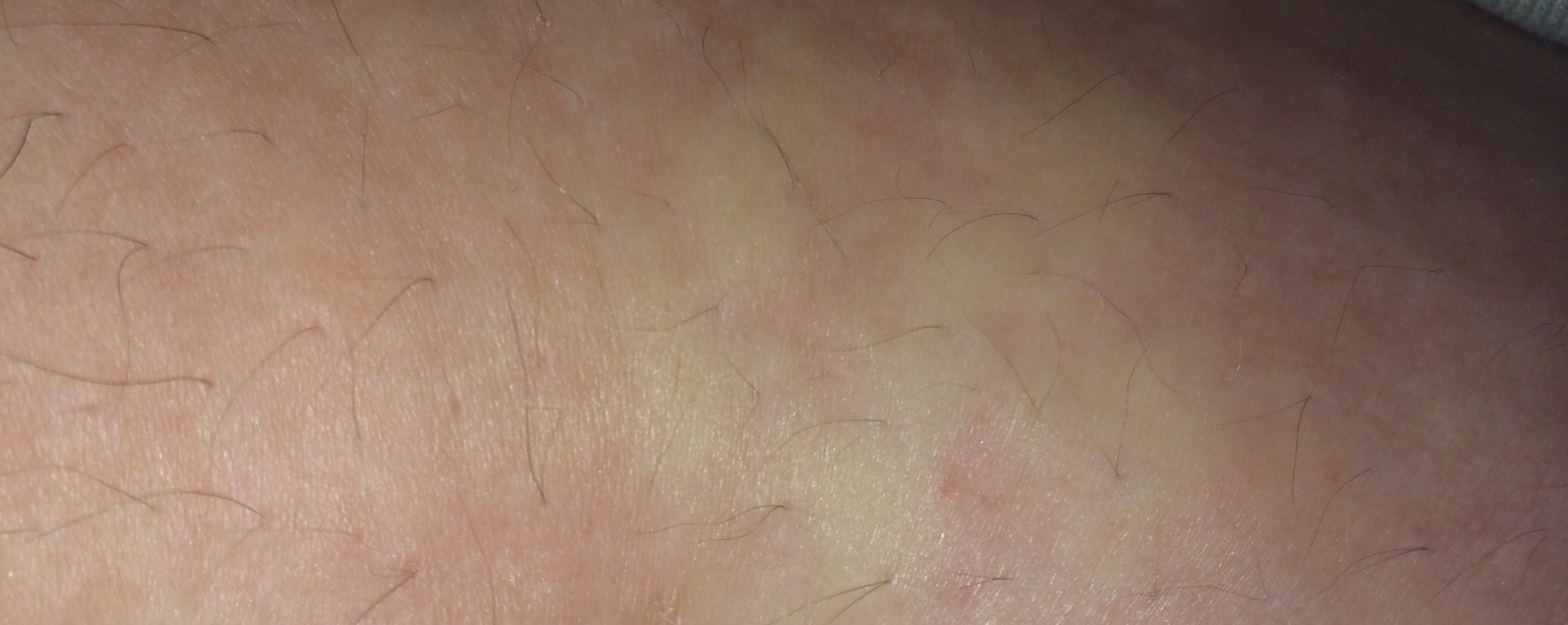 Große weiße Flecken am Bauch die Jucken (Haut, Juckreiz)