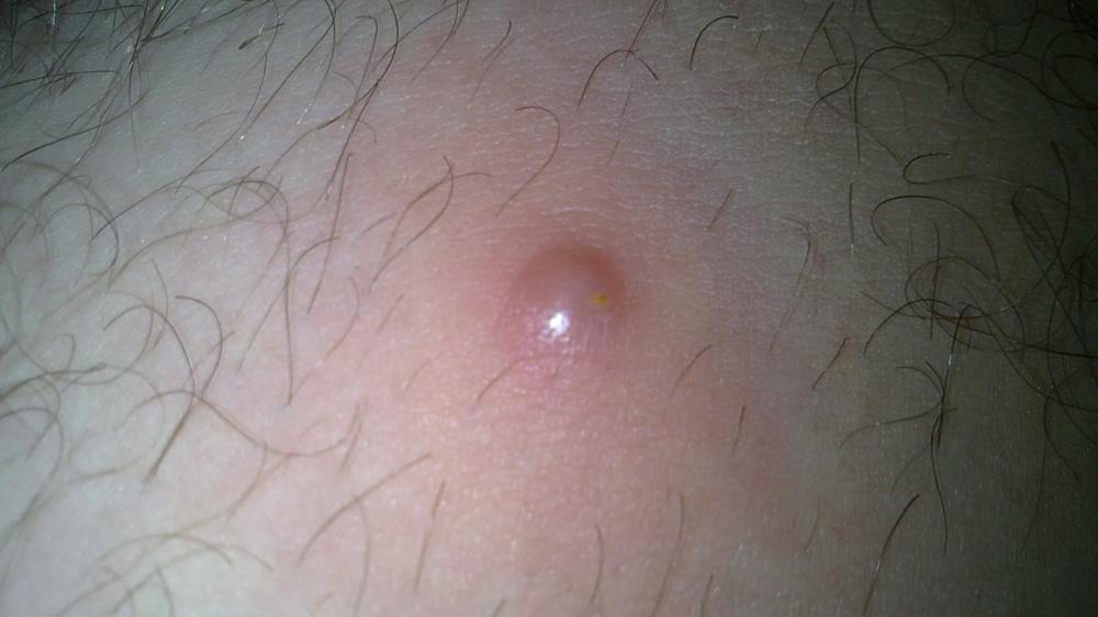 großer "Pickel" am Oberschenkel im Innenbereich (Arzt, Heilung)