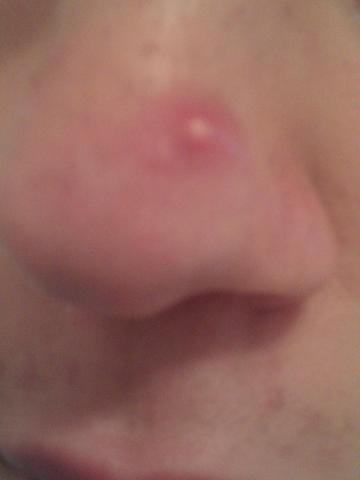 Grosser Pickel An Der Nase Haut