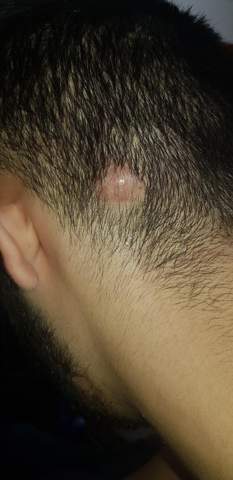 pickel am kopf ursache pickel am kopf ursache