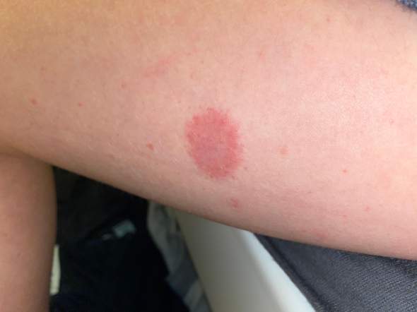Großer roter Fleck am Oberschenkel und viele kleinere? (Gesundheit und Großer roter Fleck am Oberschenkel und viele kleinere? (Gesundheit und