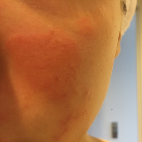 Roter Fleck auf Wange  - (Gesundheit, Haut, Rötung)