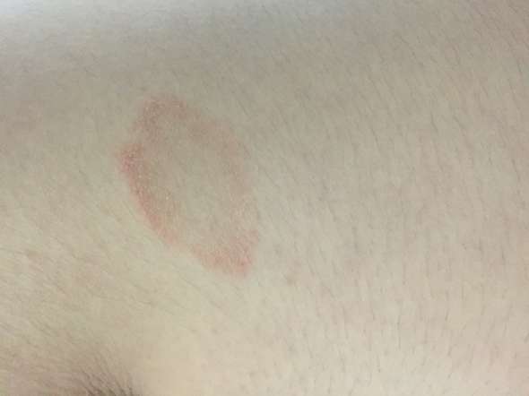 Grosser Roter Fleck Seit 1 2 Monaten Am Rucken Gesundheit Und Medizin Gesundheit Hautprobleme Grosser Roter Fleck Seit 1 2 Monaten Am Rucken Gesundheit Und Medizin Gesundheit Hautprobleme