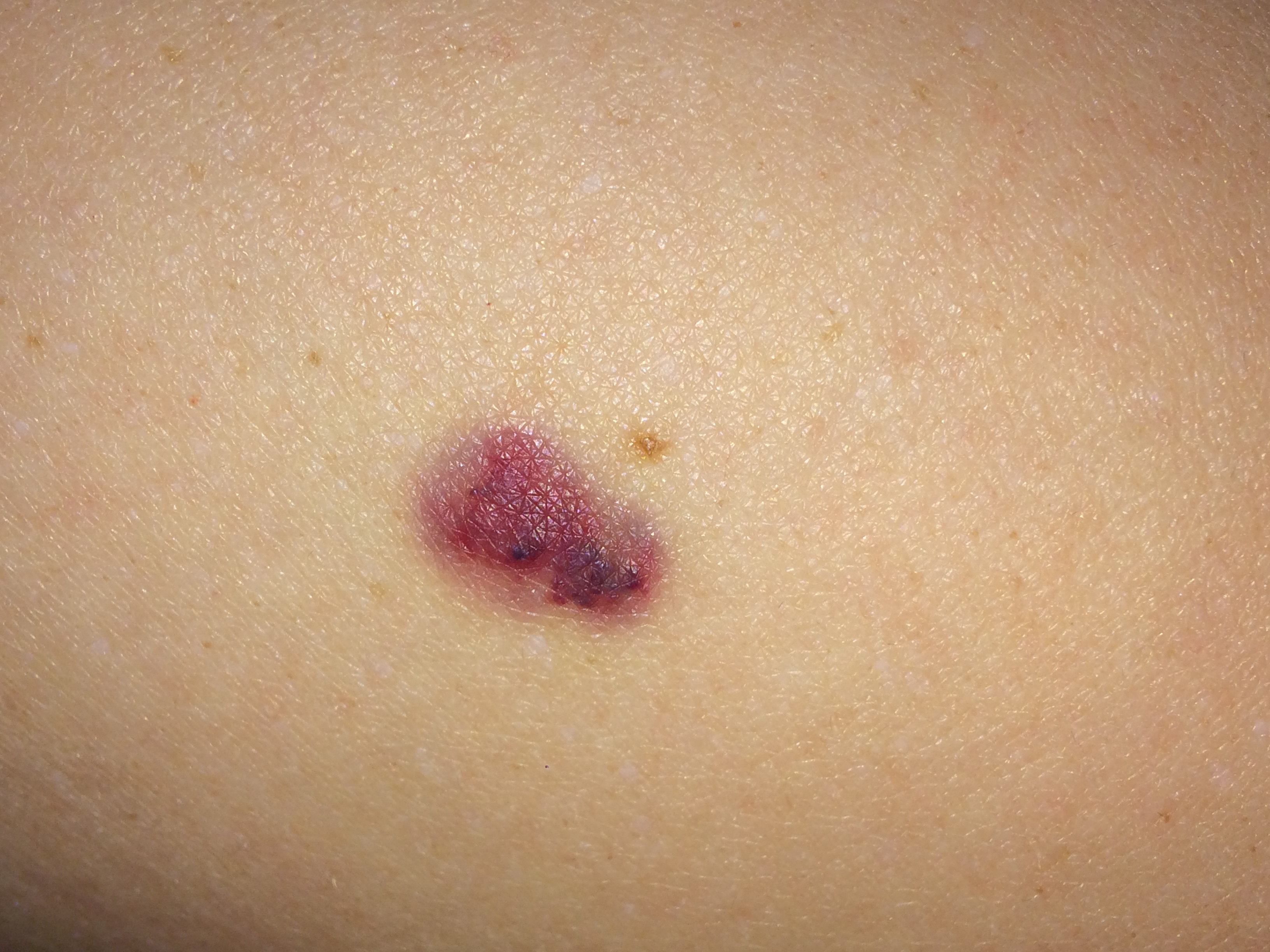 Haut blutpunkte unter der Tardive Hämangiome