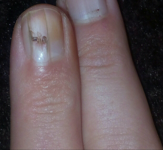 Grosser Spalt Im Nagel Wer Hat Erfahrung Verletzung Nagel Grosser Spalt Im Nagel Wer Hat Erfahrung Verletzung Nagel