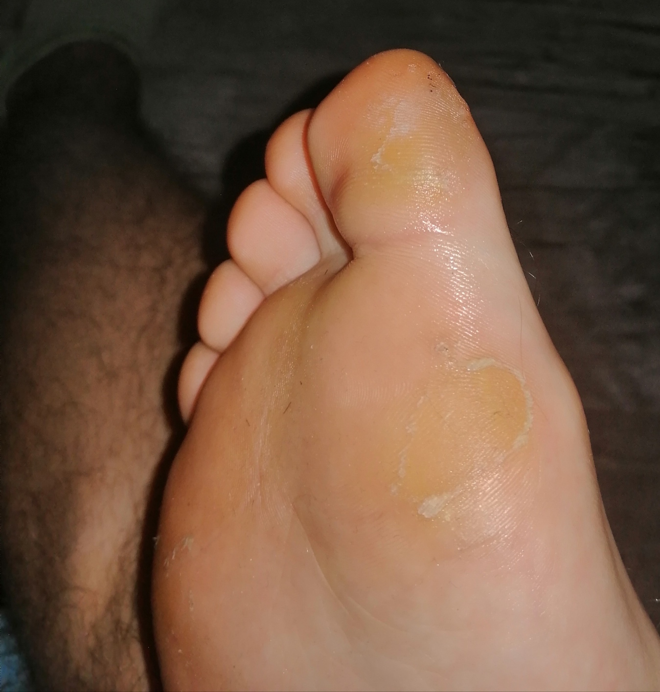 Grosser Zeh Schmerzt Hornhaut Gesundheit Und Medizin Gesundheit Medizin Grosser Zeh Schmerzt Hornhaut Gesundheit Und Medizin Gesundheit Medizin