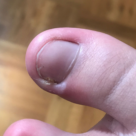 Grosser Zeh Tut An Der Seite Weh Gesundheit Und Medizin Verletzung Grosser Zeh Tut An Der Seite Weh Gesundheit Und Medizin Verletzung