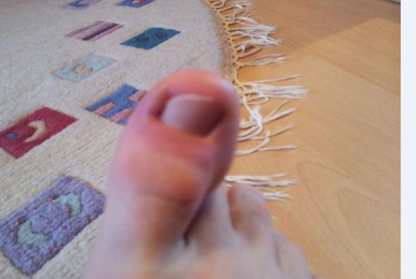 Grosser Zeh Tut Bei Beruhrung Weh Gesundheit Sport Arzt Grosser Zeh Tut Bei Beruhrung Weh Gesundheit Sport Arzt