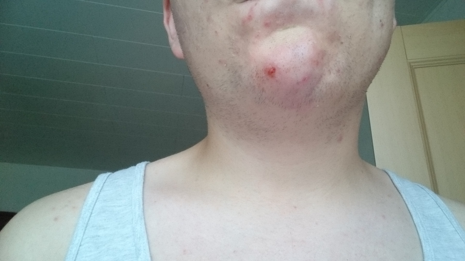 Großes Geschwür bei mir am Kinn? (Medizin) Großes Geschwür bei mir am Kinn? (Medizin)