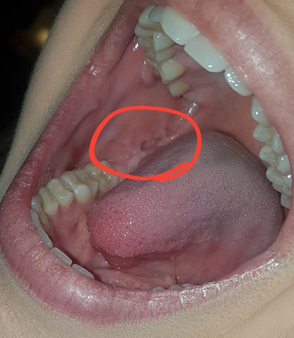 Grosses Loch In Der Mundschleimhaut Zahne Grosses Loch In Der Mundschleimhaut Zahne