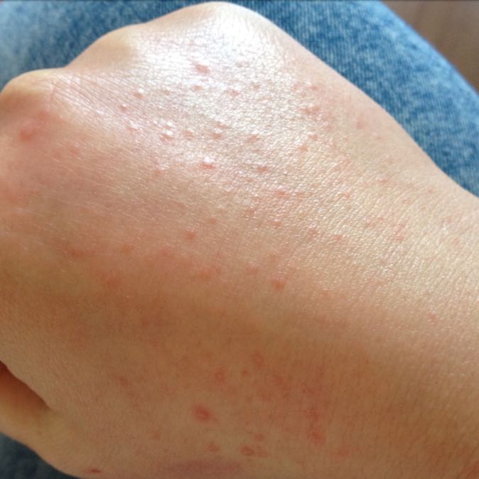 Großes Problem? Allergie? (Hautarzt, Hausarzt)