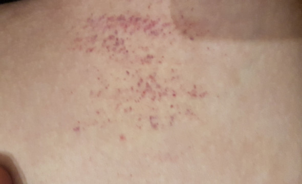 Grossflachige Petechien Gesundheit Grossflachige Petechien Gesundheit