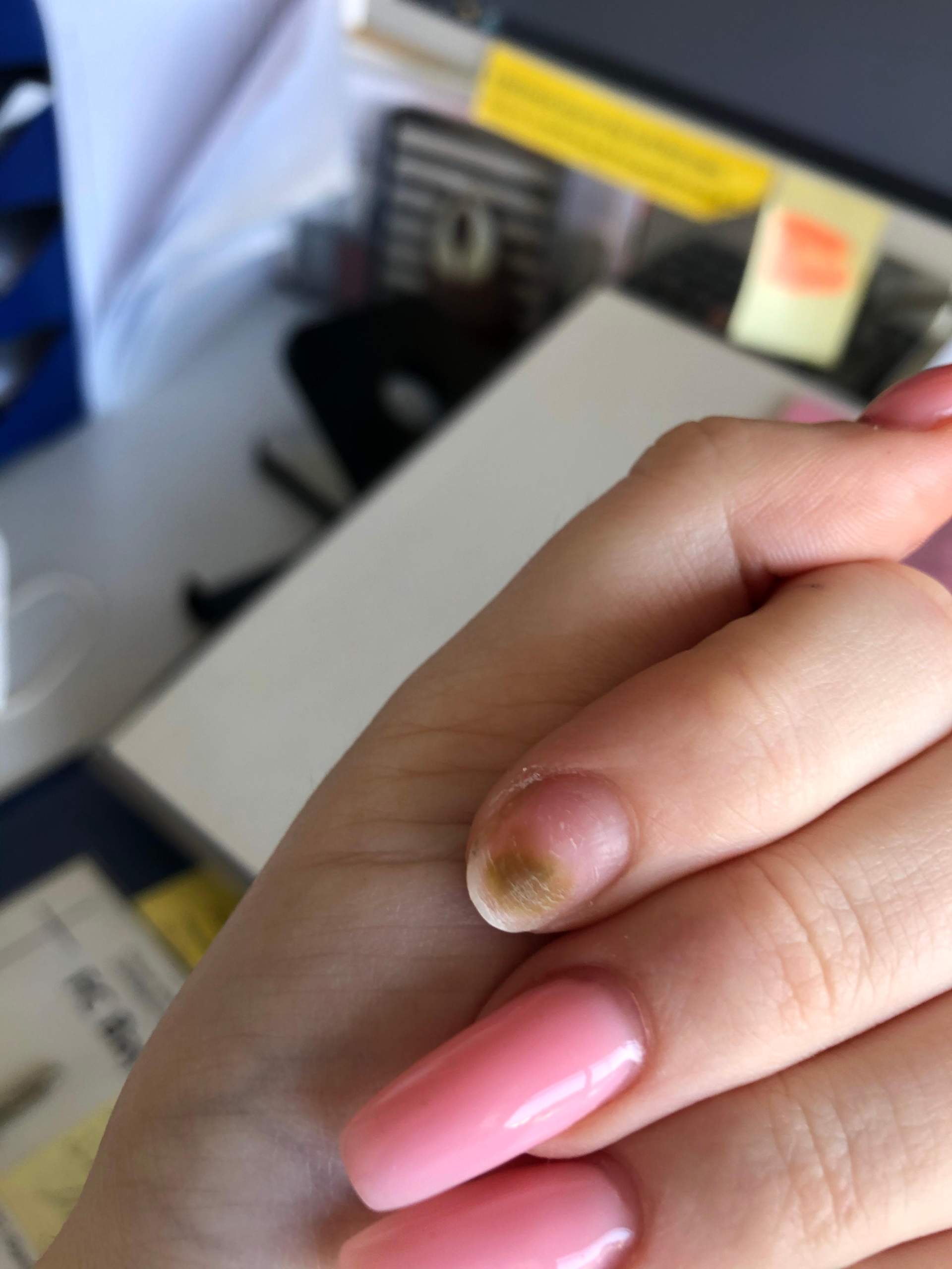 Grüner Nagel unter gelnägeln? (Gesundheit und Medizin, Gelnägel, Nagelpilz)