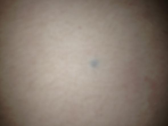 Blauer Fleck Unter Der Haut - Captions Profile
