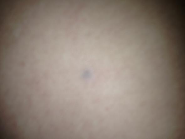 Gruner Punkt Unter Der Haut Am Rucke Gesundheit Und Medizin Gesundheit Medizin Gruner Punkt Unter Der Haut Am Rucke Gesundheit Und Medizin Gesundheit Medizin