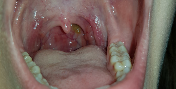 Gruner Schleim Lauft Den Rachen Runter Ohne Erkaltung Gesundheit Und Medizin Gruner Schleim Lauft Den Rachen Runter Ohne Erkaltung Gesundheit Und Medizin