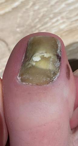 Grüner Zehen Nagel nach Nagelverlust?