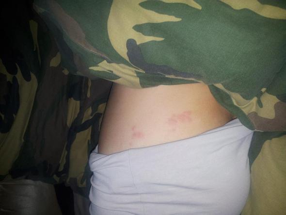 Gurtelrose Bild Medizin Krankheit Ausschlag Gurtelrose Bild Medizin Krankheit Ausschlag