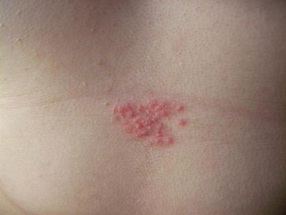 Gurtelrose Foto Arzt Krankheit Gurtelrose Foto Arzt Krankheit