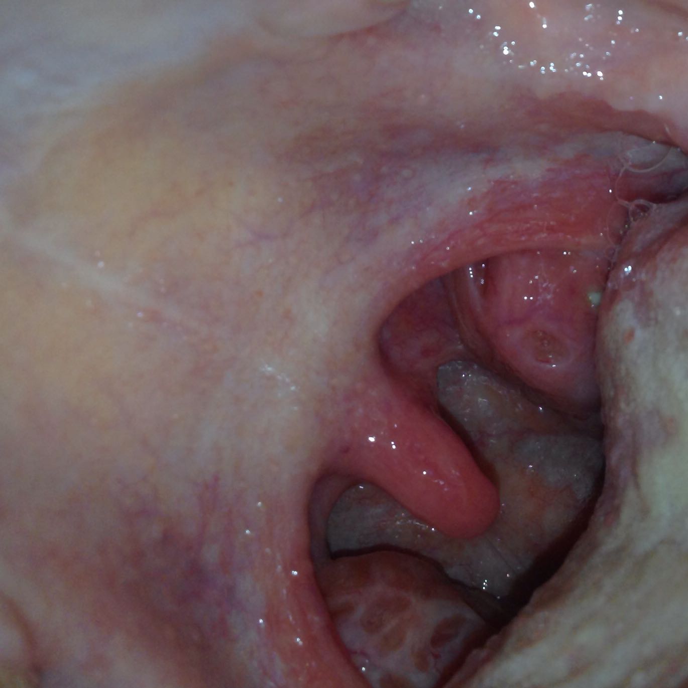 Get Pickel Auf Der Zunge Vorne PNG