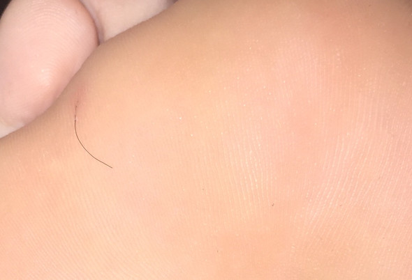 haar in fusssohle eingewachsen was soll