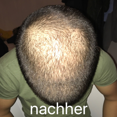 Nachher - (Haare, Haarausfall)