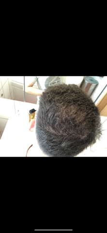 haarausfall haare beauty