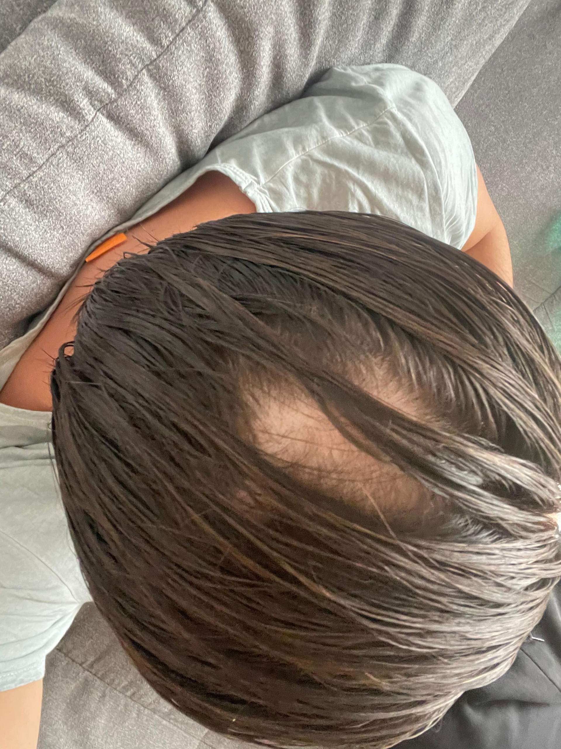 Haarausfall Haarausfall Stoppen