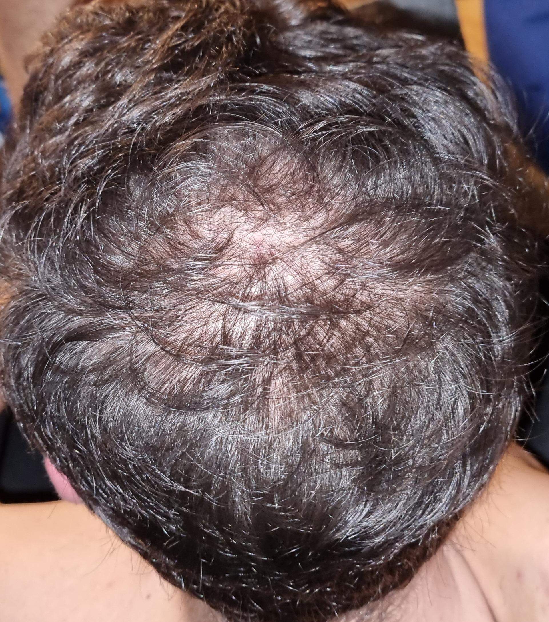 Haarausfall? (Aussehen, Pubertät, Friseur)