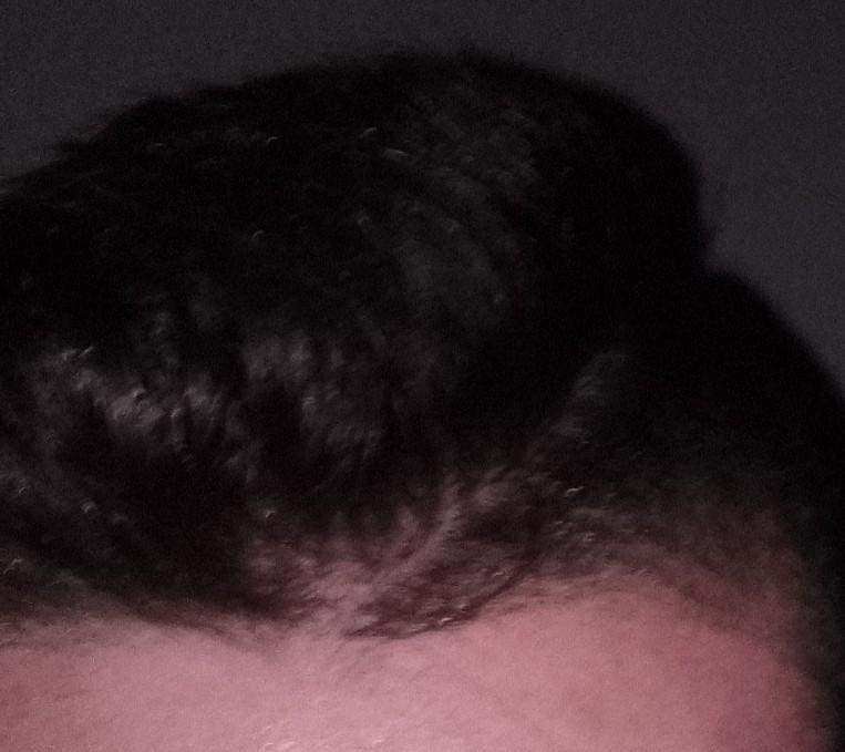 Haarausfall? (Pubertät, Kopfhaut, Haarwachstum)