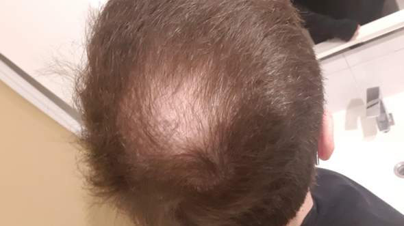 Haarausfall Ab Wann Glatze Rasieren