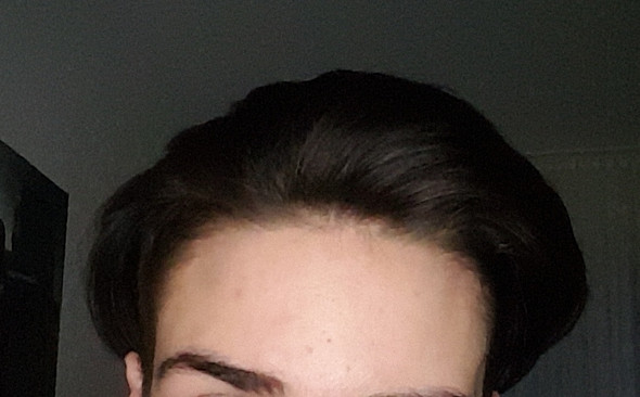 haarausfall am haaransatz haare haut