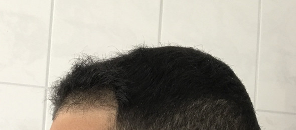 Haare - (Haare, Haarausfall, Haaransatz)