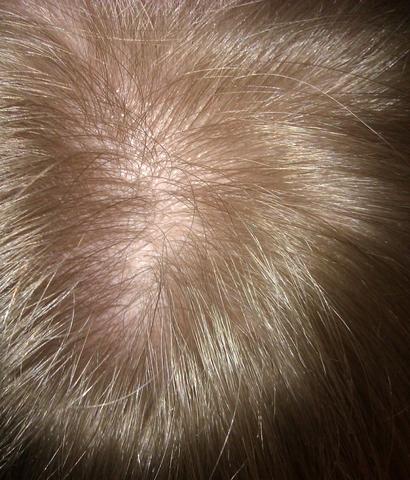 haarausfall lichte stelle foto