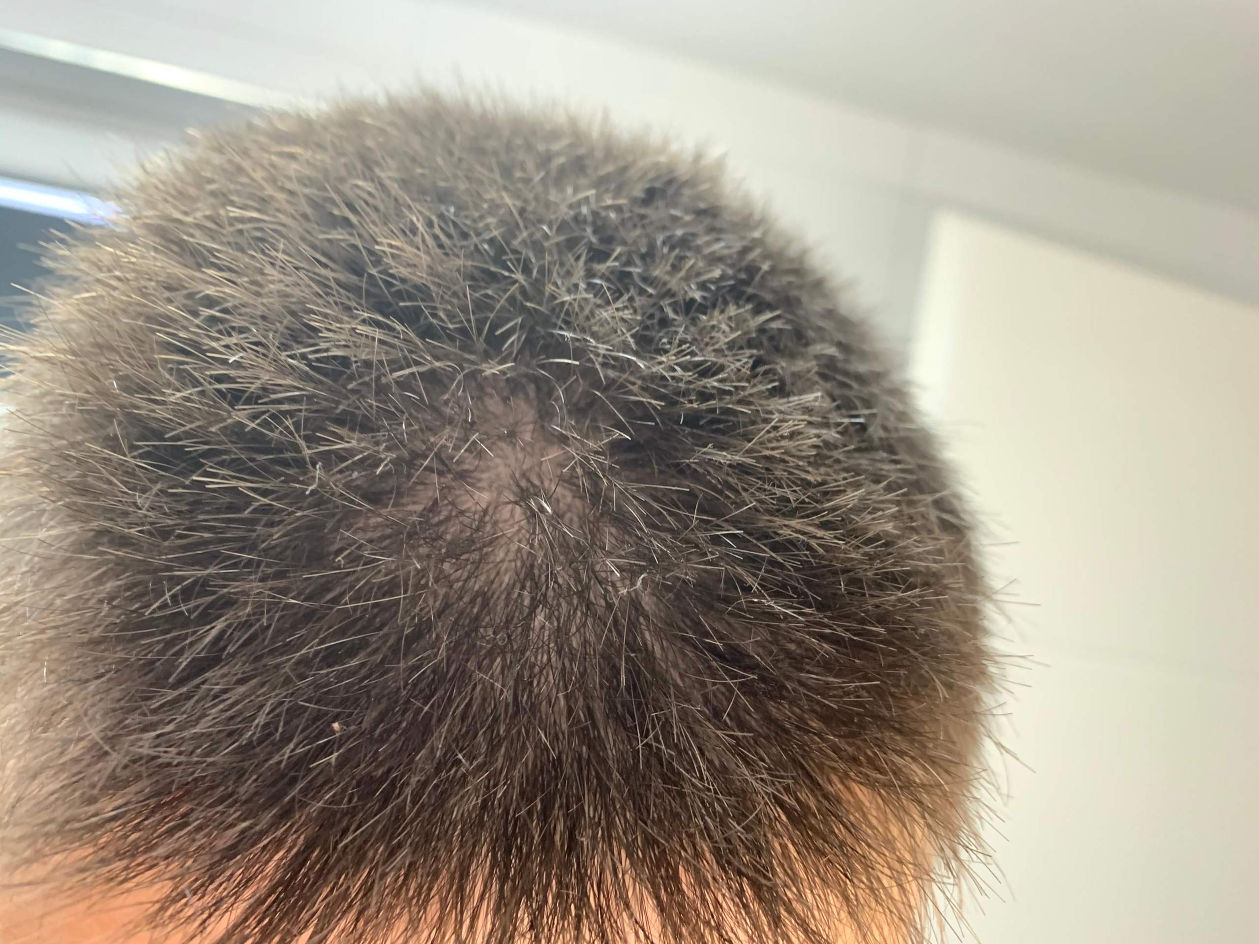 Haarausfall mit 14? (Gesundheit und Medizin, Gesundheit, Haare)