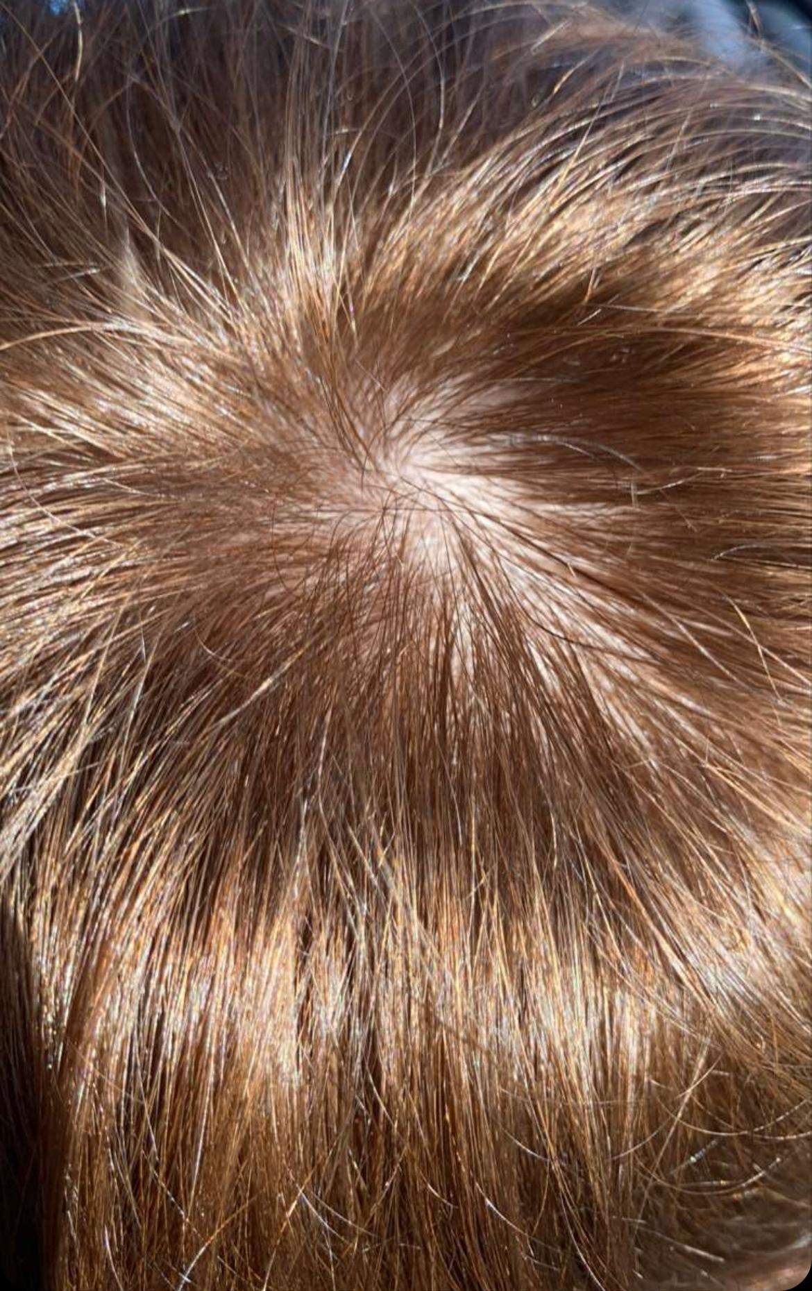 Haarausfall mit 14? (Jungs, Glatze)