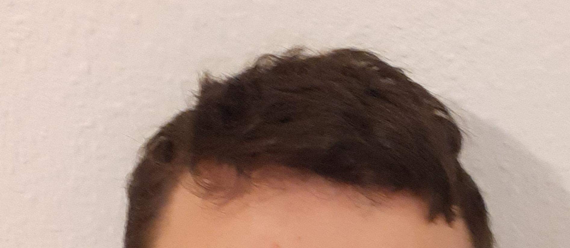 Haarausfall mit 15? (Aussehen, Pubertät, Pflege)