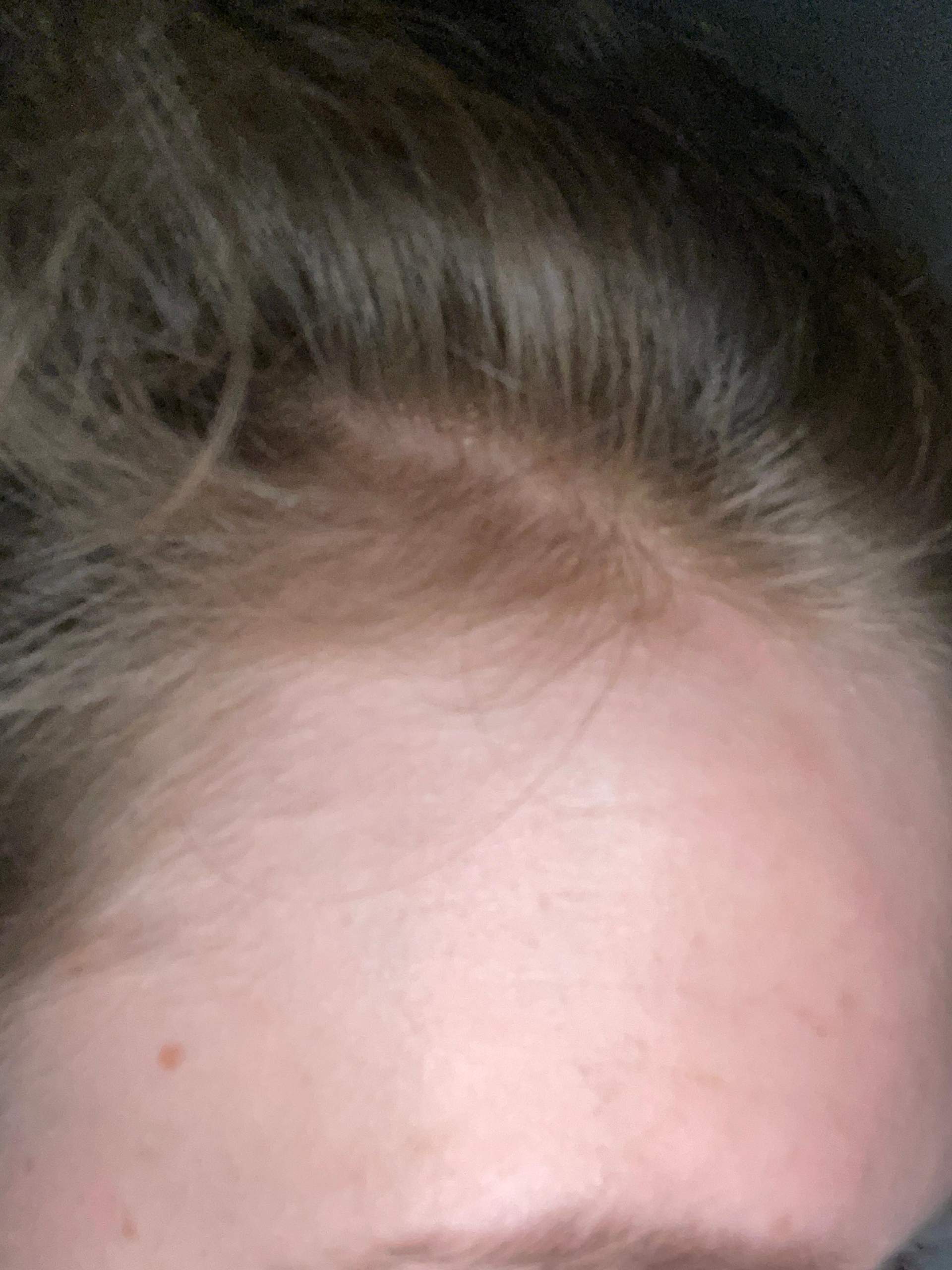 Haarausfall mit 15? (Männer, Haarpflege, Haarwachstum)
