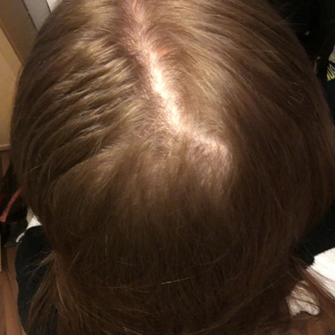 haarausfall mit 16 männlich