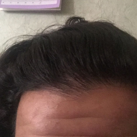 haarausfall mit 16 männlich