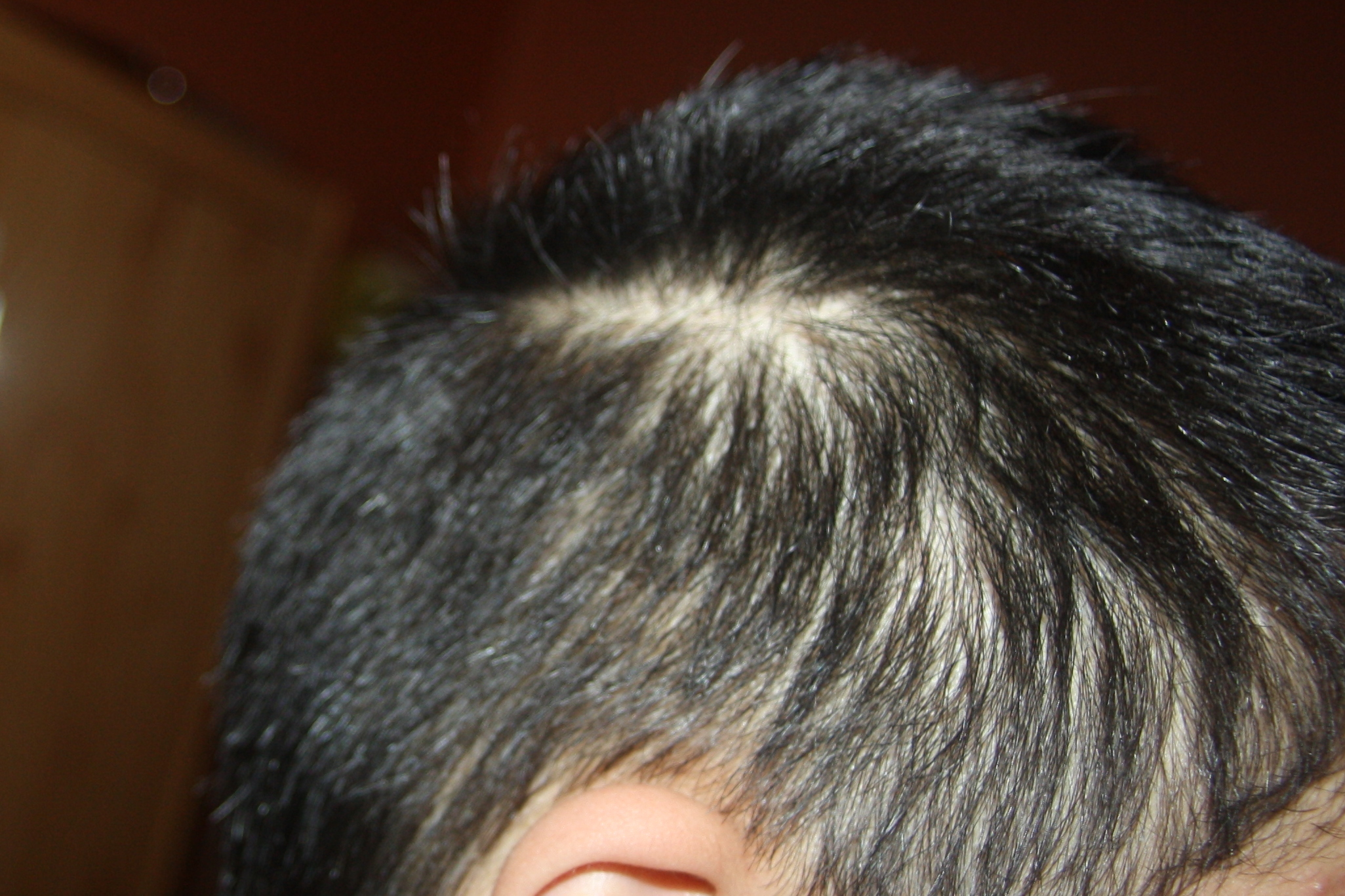 Haarausfall Mit 17 Ist Das Besorgniserregend Fotos Haare