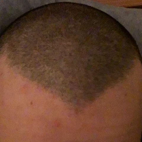 Haarausfall Mit 17 Mannlich Gesundheit Haare Arzt Haarausfall Mit 17 Mannlich Gesundheit Haare Arzt