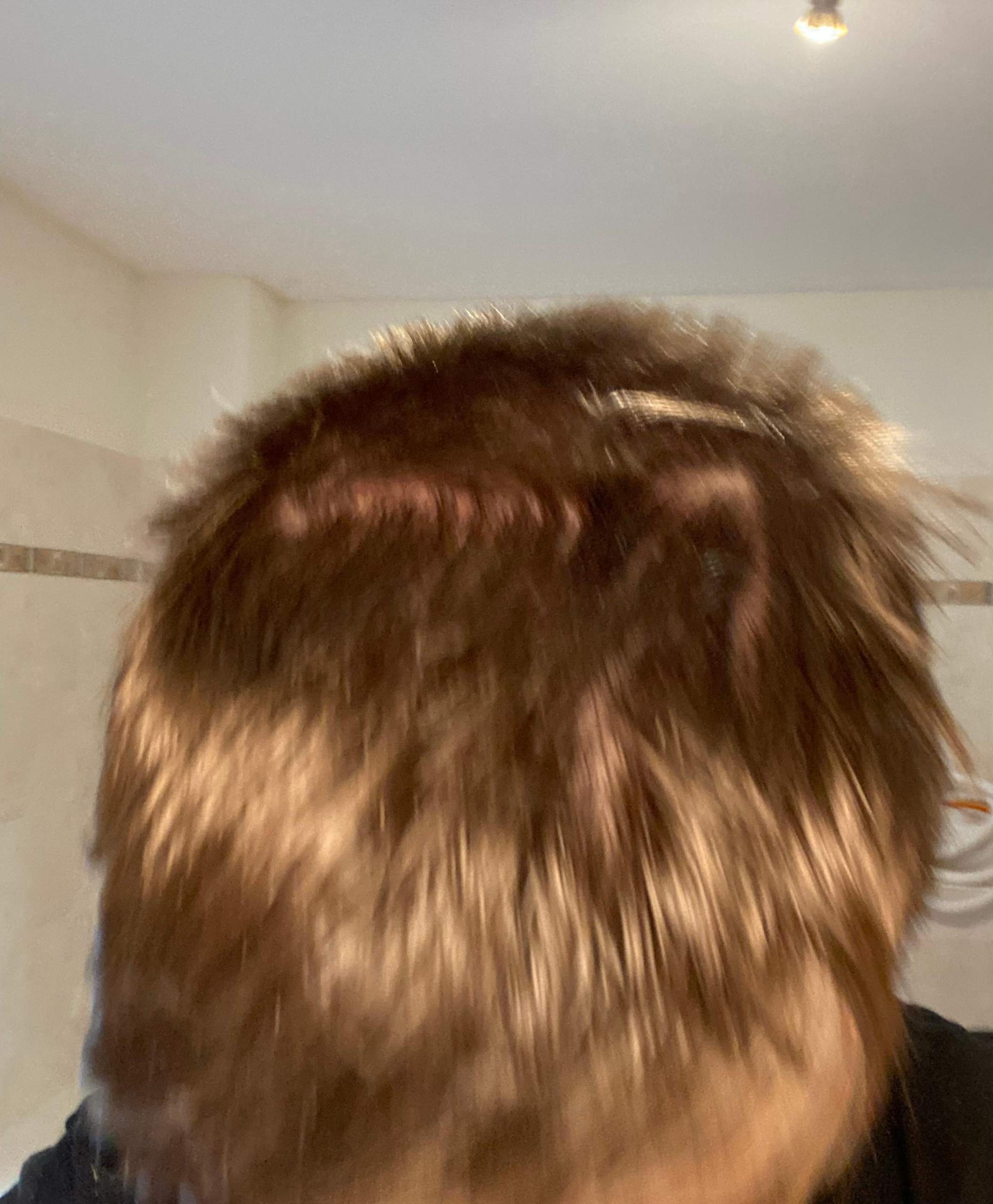 Haarausfall mit 18? (Männer, Aussehen, Pubertät)