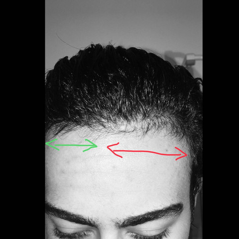 Grün: dichte Stelle 
Rot: vom vorderen Haaransatz bis zur linken Seite kahler  - (Gesundheit und Medizin, Haare, Haarausfall)