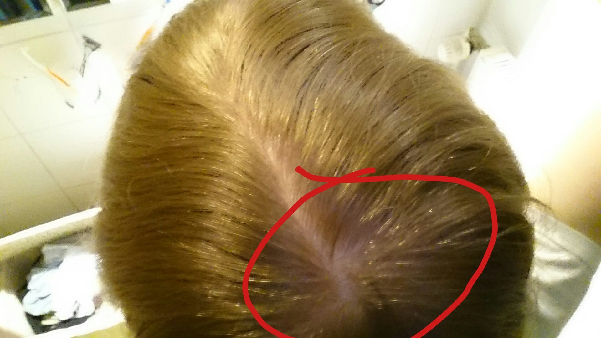 Haarausfall oder bloß ein Wirbel? (Stress, hinterkopf)