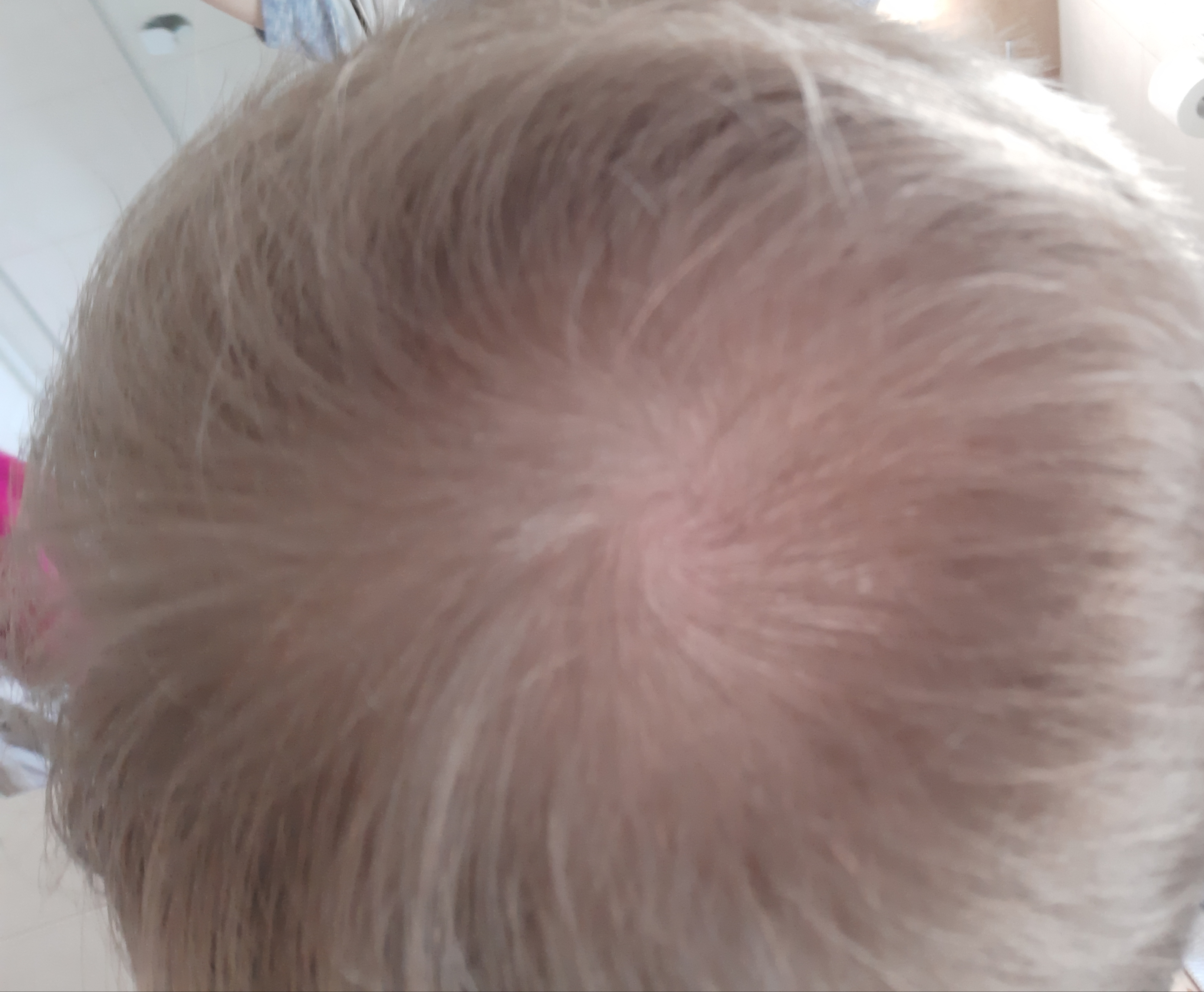 haarausfall oder normaler wirbel haare