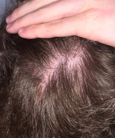 Haarausfall Oder Warum Sieht Man Meine Kopfhaut 18 Haare Duenne Haare Dunnes Haar