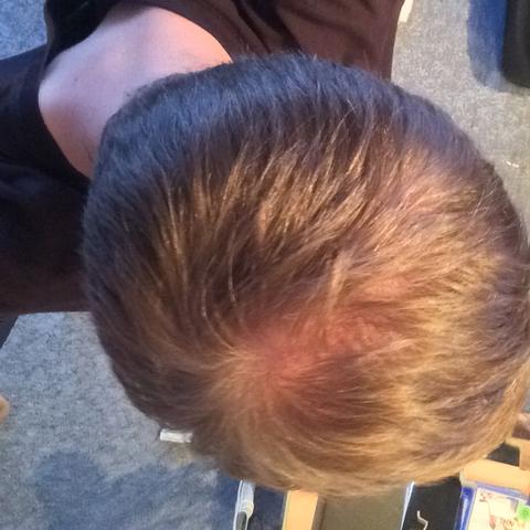 Kopf von oben  - (Haare, Haarausfall, 20 Jahre)