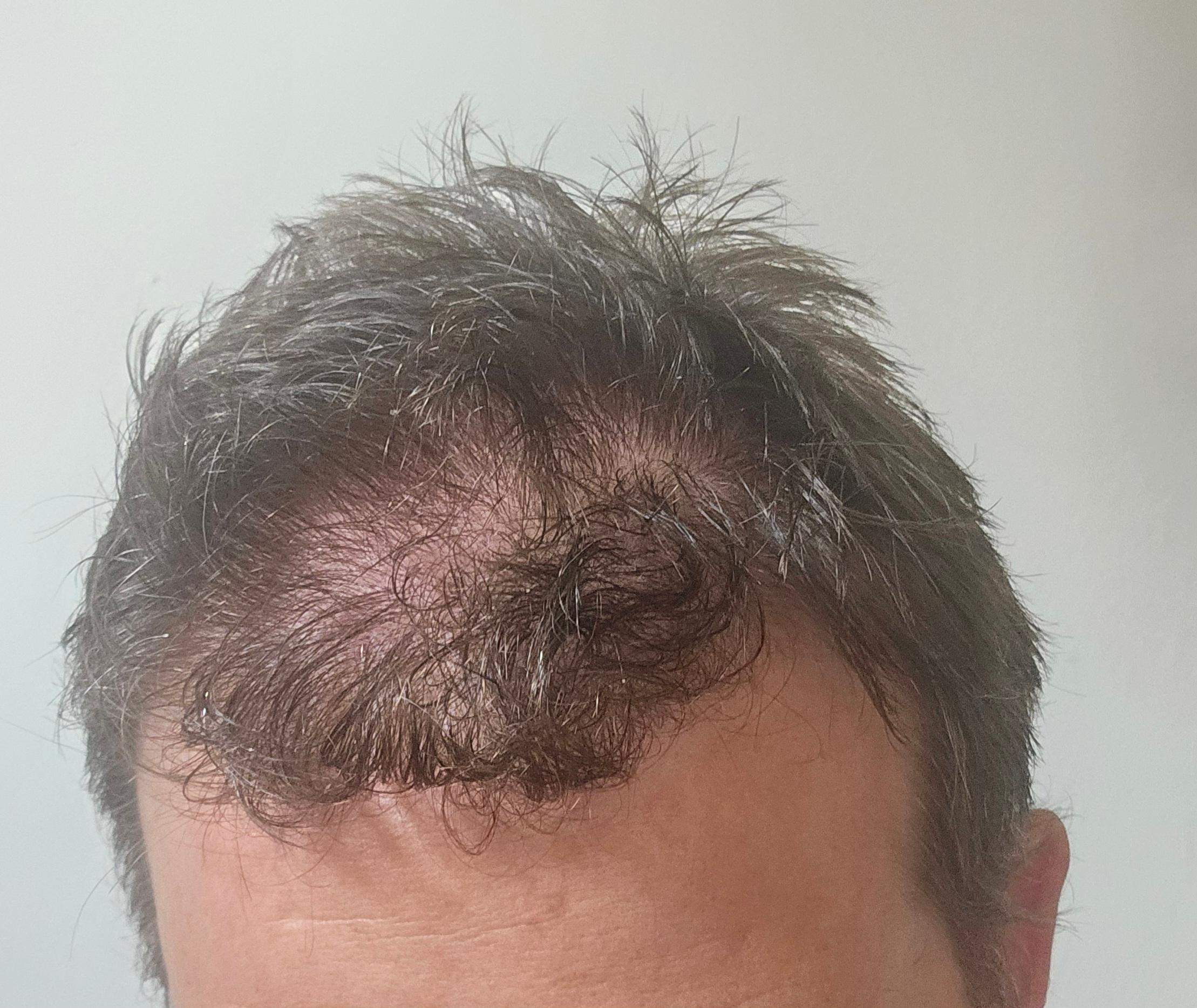 Haarausfall und Hauptproblem, welche Frisur? (Mädchen, Frauen, Männer)